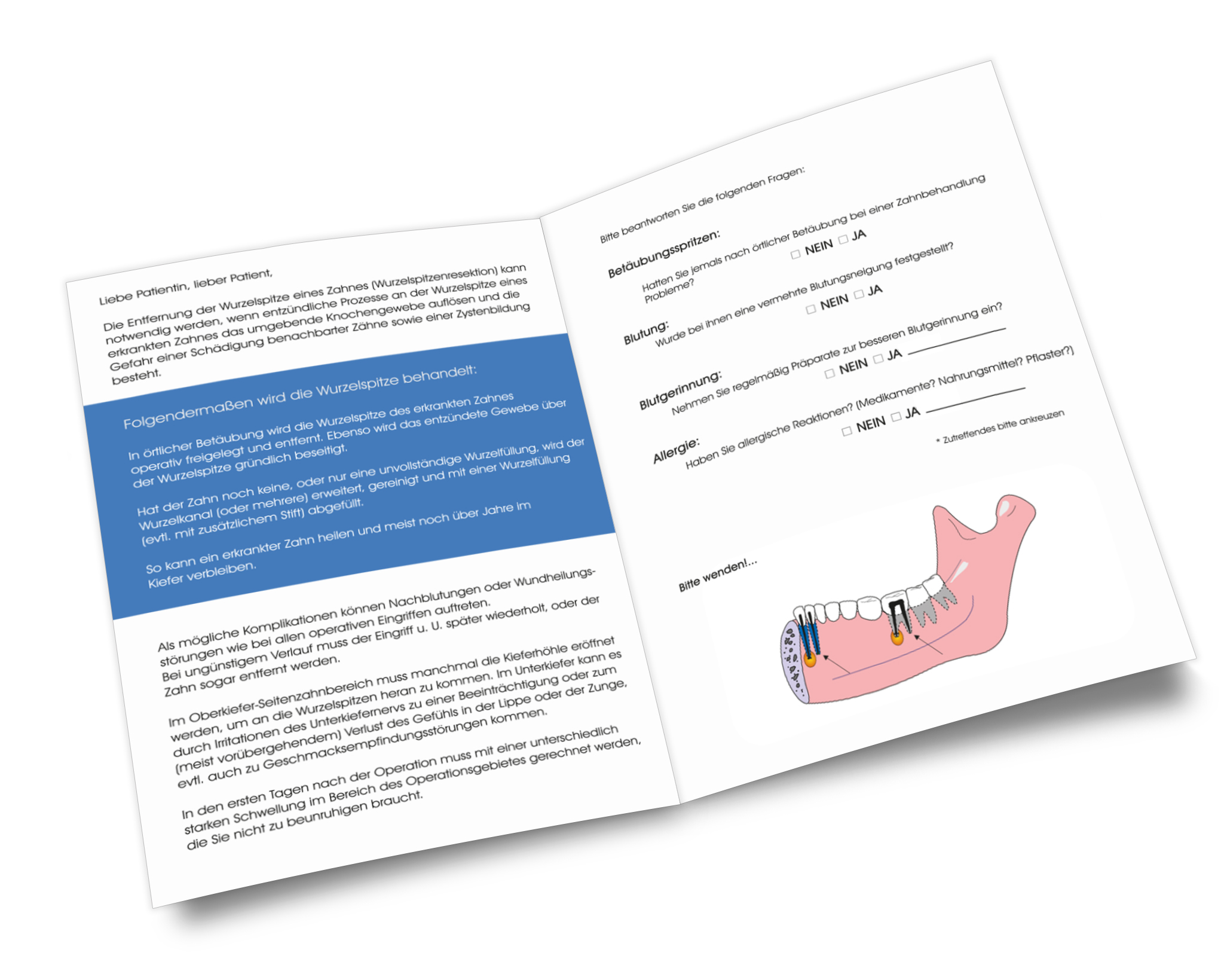 Patienten-Info Entfernung einer Wurzelspitze