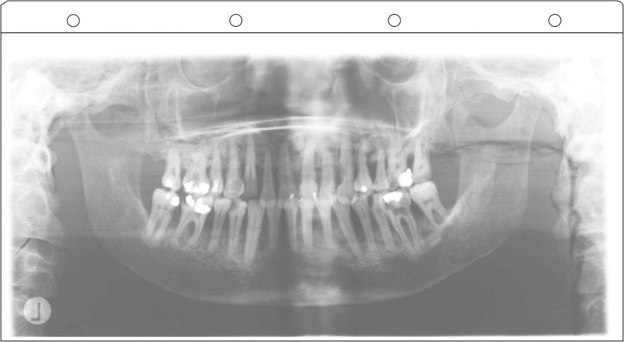 Röntgen-Panoramasichthüllen 12 x 30 cm, Typ 1011